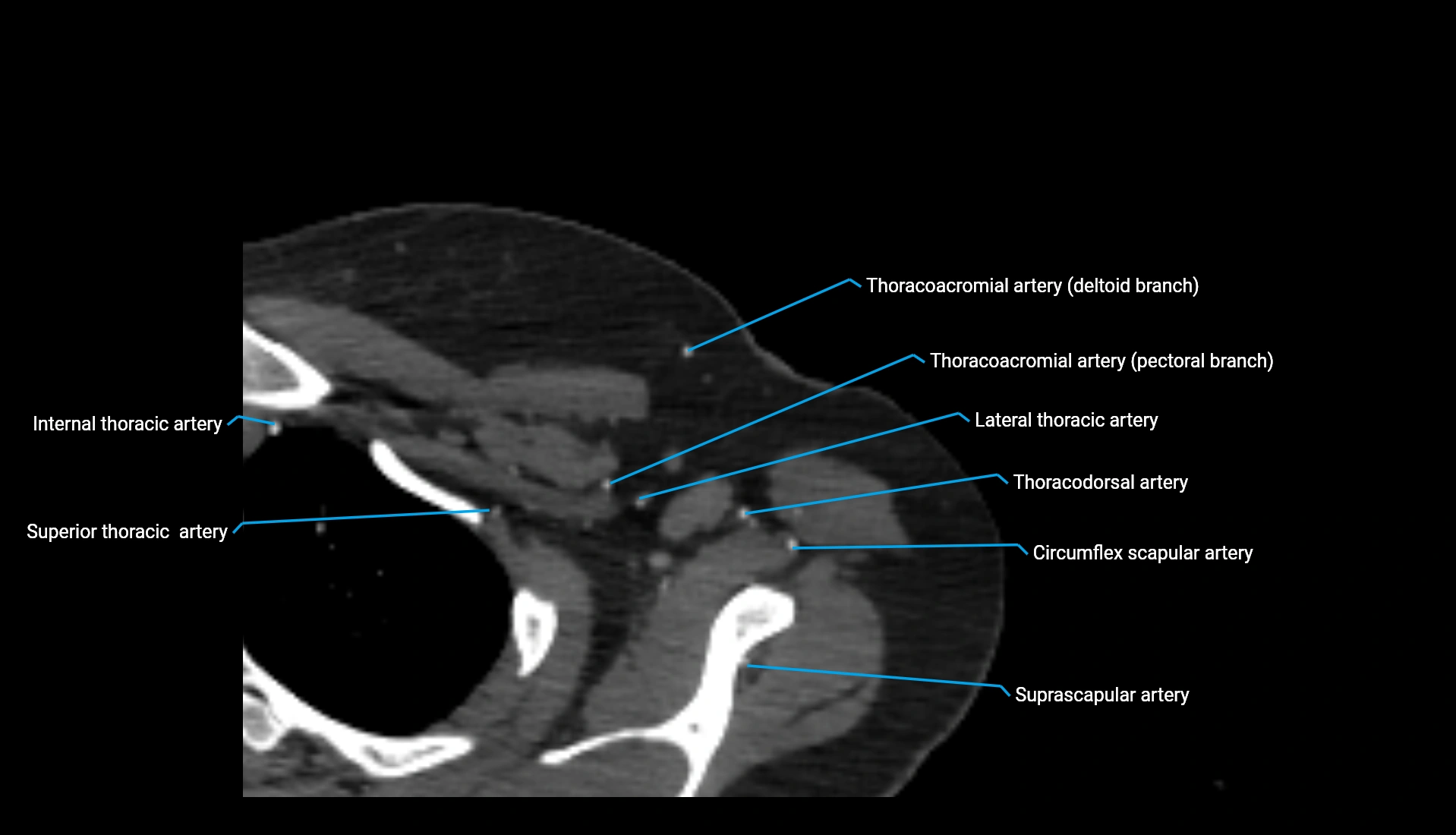 CTA upper limb axial cross sectional anatomy labelled image 340 (1).webp